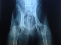 Bella's healed femur and hip socket on August 6th, 2008.